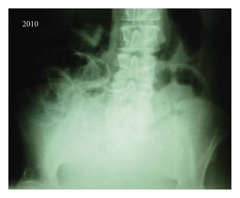 Plain Abdominal Films Of The Patient Without Any Contrast Media