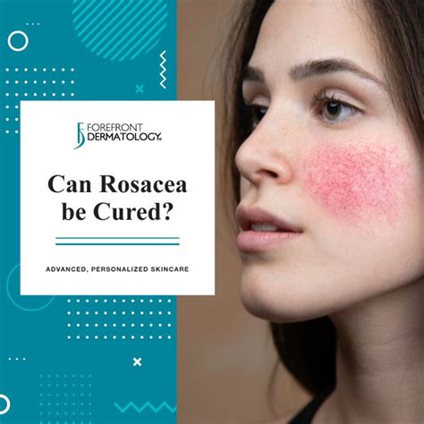 Can Rosacea Be Cured Forefront Dermatology Forefront Dermatology