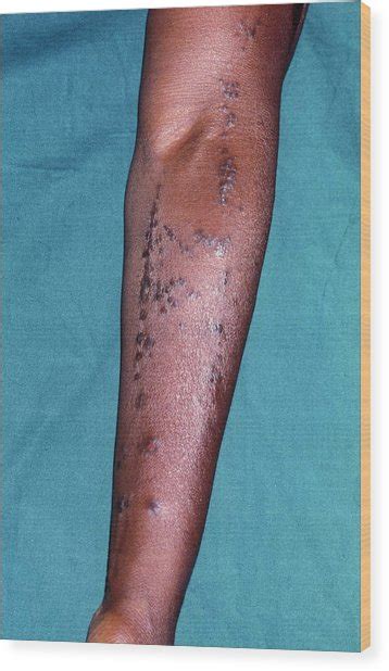 Lichen Planus Skin Disease Stock Image M Science Photo My Xxx Hot Girl