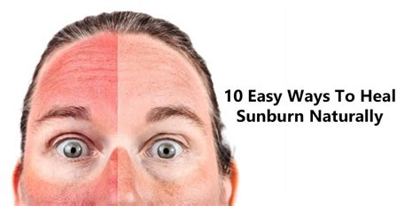 10 Easy Ways To Heal Sunburn Naturally Doctor Asky