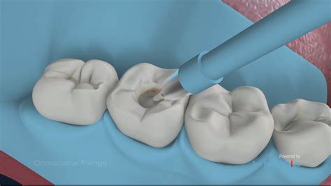 Composite Fillings Video Medical Video Library