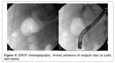 Clinical Case Reports Cholangiography