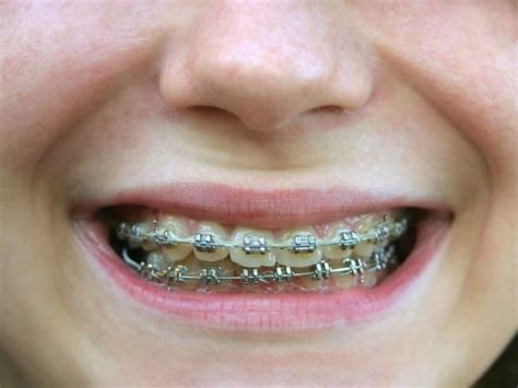 what you should know about trend diy braces nice orthodontics braces diy braces orthodontics