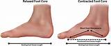 Photos of Foot Muscle Strengthening