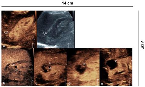 Diagnostics Free Full Text Role Of Contrast Enhanced Ultrasound