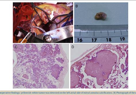 Figure 2 From A Case Of Cardiac Calcified Amorphous Tumor Cardiac Cat