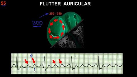 Curso De Electrocardiografia 55 Flutter Y FibrilaciÓn Auriculares