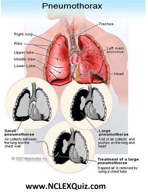 Pneumothorax Vs Atelectasis