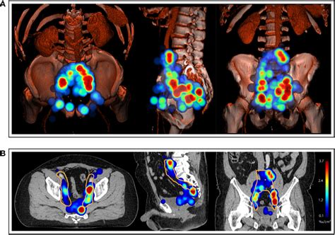 Frontiers The Distribution Of Pelvic Nodal Metastases In Prostate