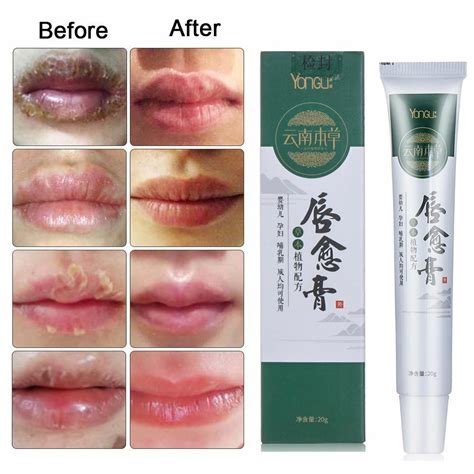 Anti Chapped Oil Cheilitis Treatment Cold Sores Lip Cream Nourish Lip