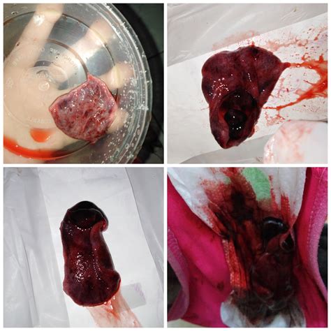 Implantation Bleeding Or Period Implantation Bleeding Causes
