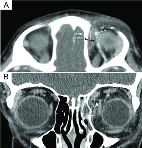 Orbital Abscess Volume Calculation Axial And Coronal Views Of A Child