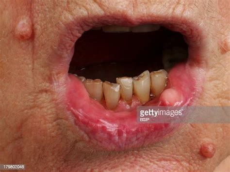 Mouth Cancer Stock Photos And Pictures Getty Images