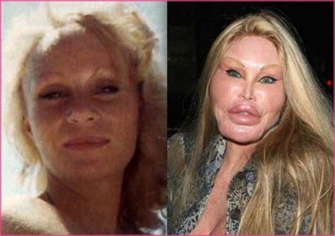 Catwoman Plastic Surgery Picture Evidence Before And After Photo
