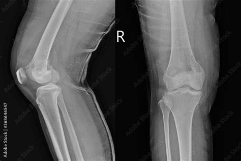 X Ray Knee Joint Aplateralviews Showing Osteosarcoma Stock Photo