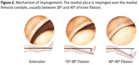 Knee Plica Syndrome Exercises P Rehab