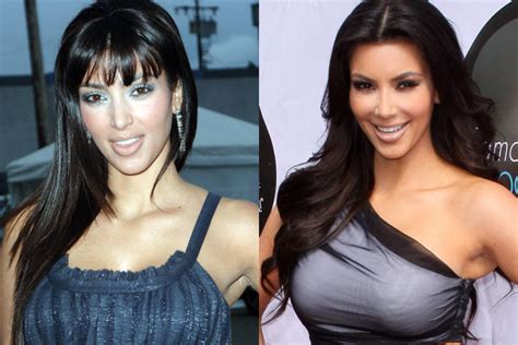 Kim Kardashian Plastic Surgery Before And After Nose Job Botox And