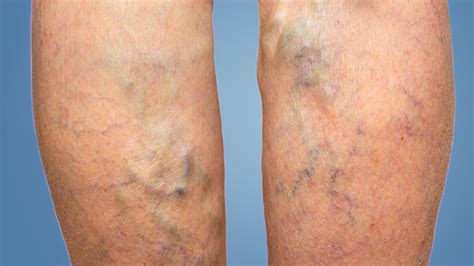 Get Rid Of Painful Varicose Veins In Your Legs Today Mvv Clinic