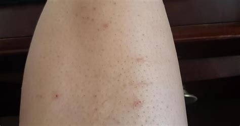 40 Yr Old Leg With Itchy Bumps After Using At Home Lazer Hair Remover Album On Imgur