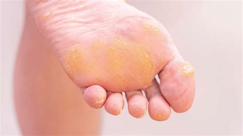 Corns And Calluses Causes Symptoms And Treatment The Feet People Podiatry