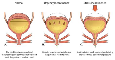 Eau guidelines on urinary incontinence in adultseuropean association of urology, 2017. Urinary Incontinence