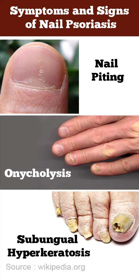 Aggregate More Than 133 Pitting Of Nails In Psoriasis Best Noithatsivn