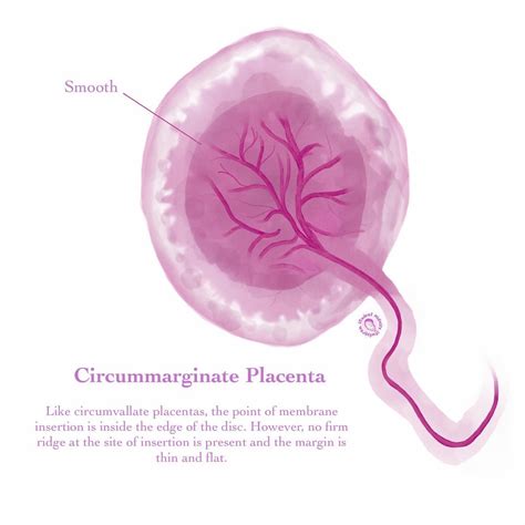 Circummarginate Placenta Placenta Nursing Student Tips Midwifery