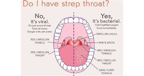 How Do You Know You Have Strep Throat And Not Just A Viral Throat