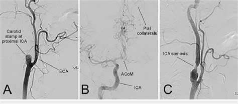 Digital Subtraction Angiography Confirming Left Internal Carotid Artery