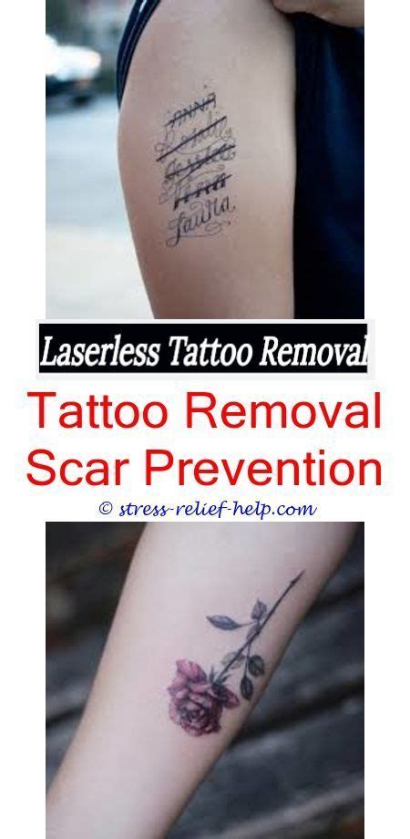 Laser tattoo removal laser tattoo removal, with the right laser (s) should not leave a scar. Laser Tattoo Removal Leave Scars - Best Tattoo Ideas