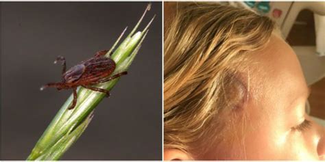 7 Year Olds Tick Bite Stumped Doctors Unusual Bullseye Rash Hid Lyme