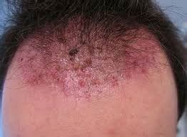 A cyst from ingrown hair can start and grow in areas covered with skin including scalp, on the face, under armpits, pubic area and groin. Ingrown hair