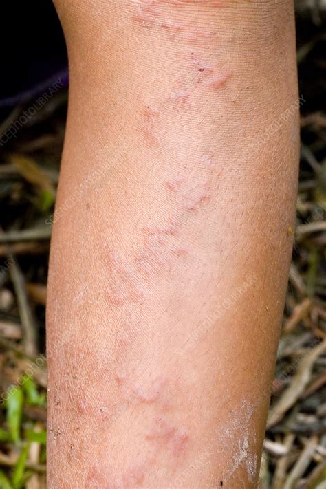 Cutaneous Larva Migrans Stock Image M2000254 Science Photo Library