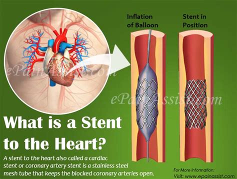 What Is A Stent To The Heart