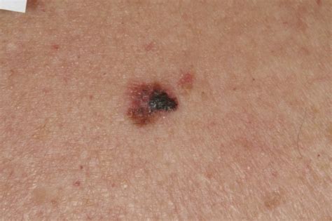Nodular Melanoma Pictures Early Pictures Photos