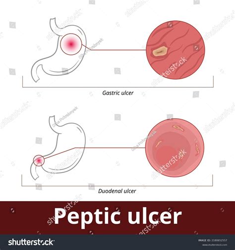 Peptic Ulcer Visualization Stomach Disease Including Stock Vector