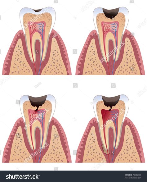 Diagram Of Tooth With Caries Stages Stock Vector Illustration 78582436