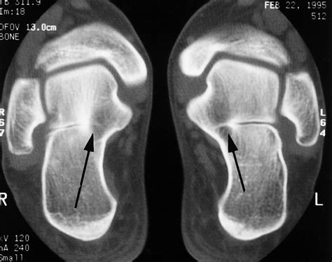 Congenital Tarsal Coalition Multimodality Evaluation With Emphasis On