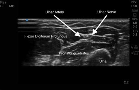 Ultrasound Guided Median And Ulnar Nerve Blocks In The Forearm To