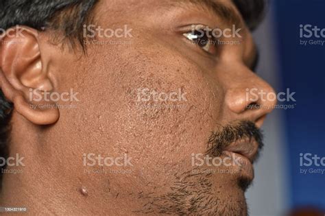 Close Up Of Pimples Marks On Mans Face Deep Acne Scars On The Cheek