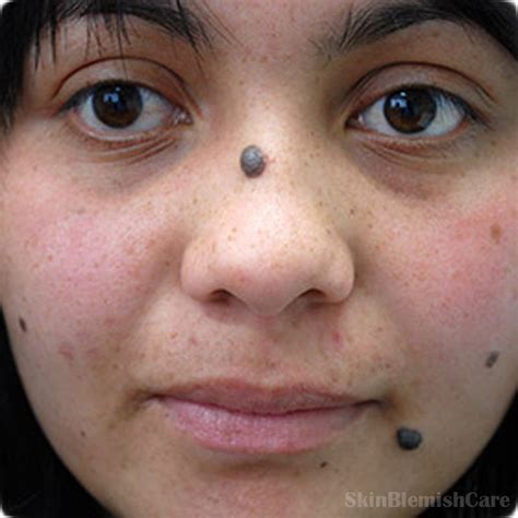 Face Mole Moles On Face Facial Mole Skin Tag Removal