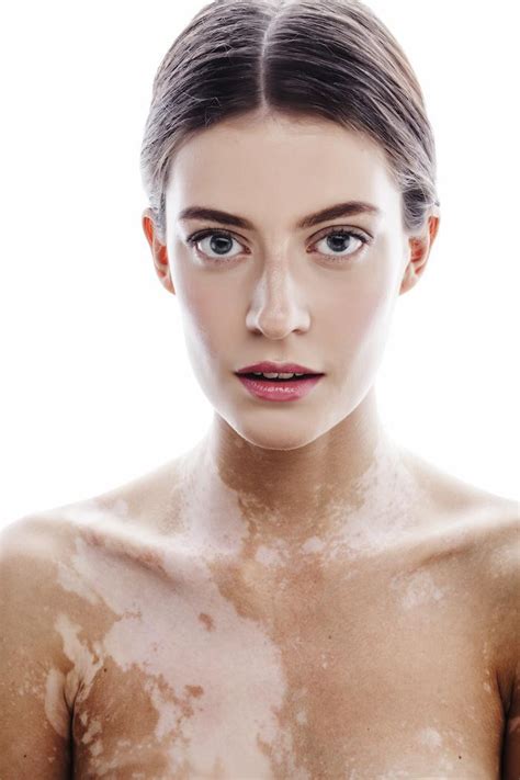Look For These 5 Common Signs Of Vitiligo Apex Dermatology Skin Care
