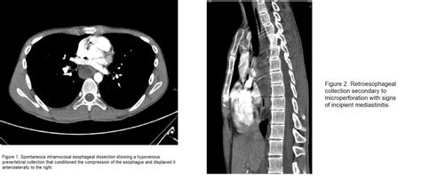 Intramural Esophageal Dissection A Case Report Serau Sociedad