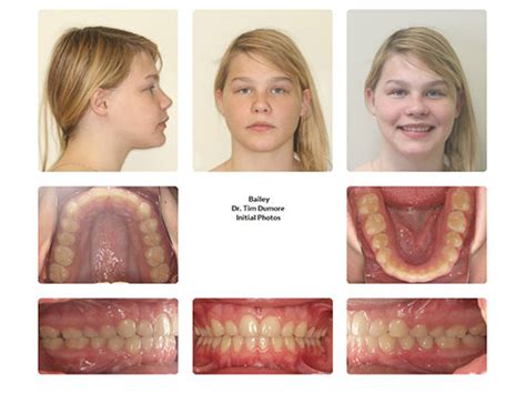 Jaw Overbite Surgery And Braces Before And After Winnipeg Orthodontist
