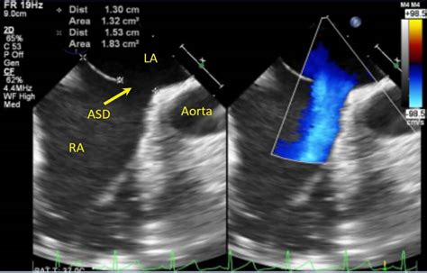 Chapter Imaging Of Atrial And Ventricular Septal Defects