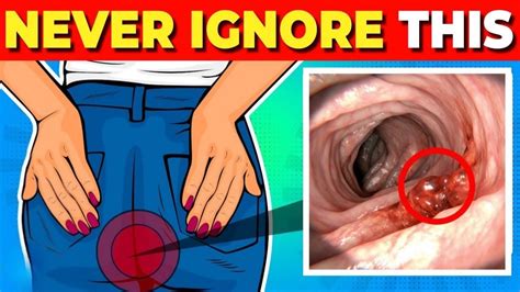Early Warning Signs Of Colon Cancer You Should Not Ignore Youtube