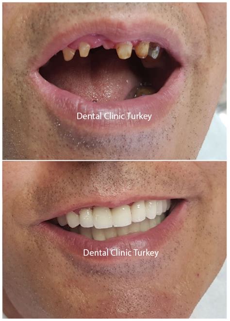 Single Tooth Implant Single Tooth Replacement Dental Clinic Turkey