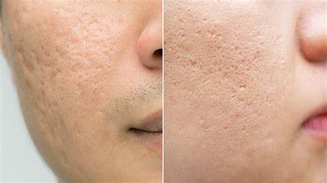 How To Improve Acne Scars