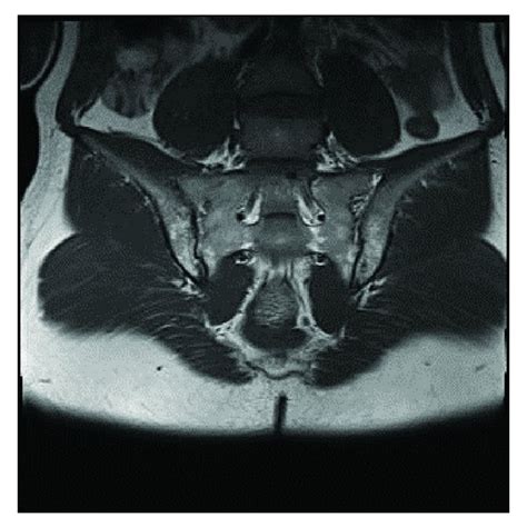 Bilateral Sacroiliitis In Mri Of The Same Patient Download