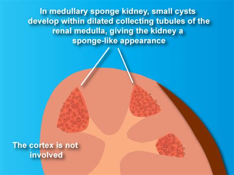 What Is Medullary Sponge Kidney